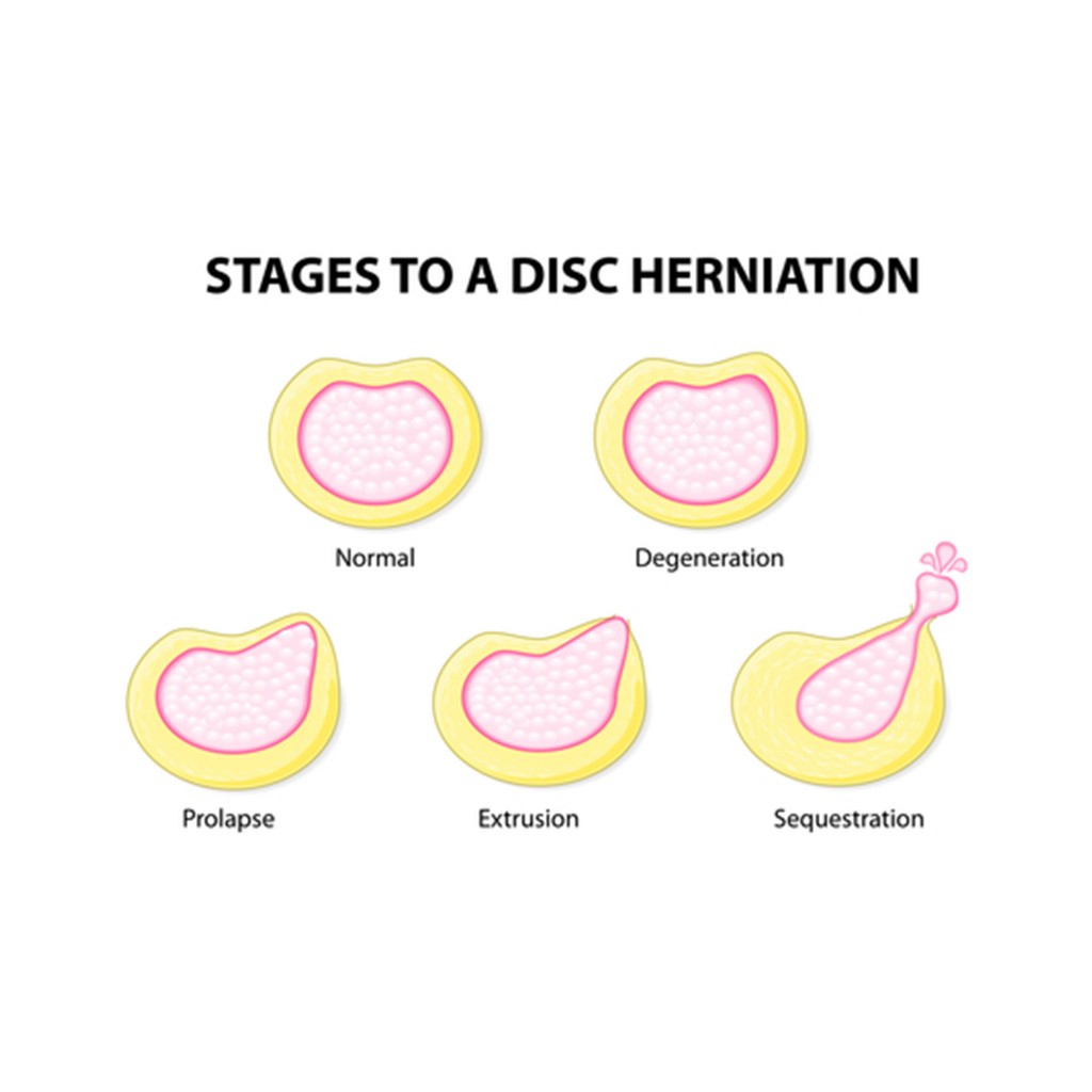 Slipped Disc Treatment Singapore Slip Disc Pain Relief Specialist