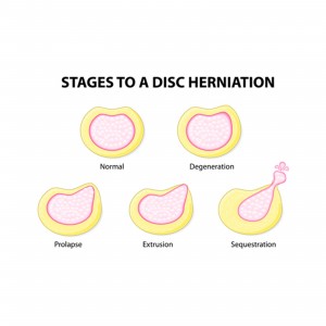 Non-Invasive Slipped Disc Clinic Treatment Singapore
