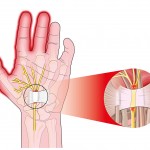 Carpal Tunnel Syndrome