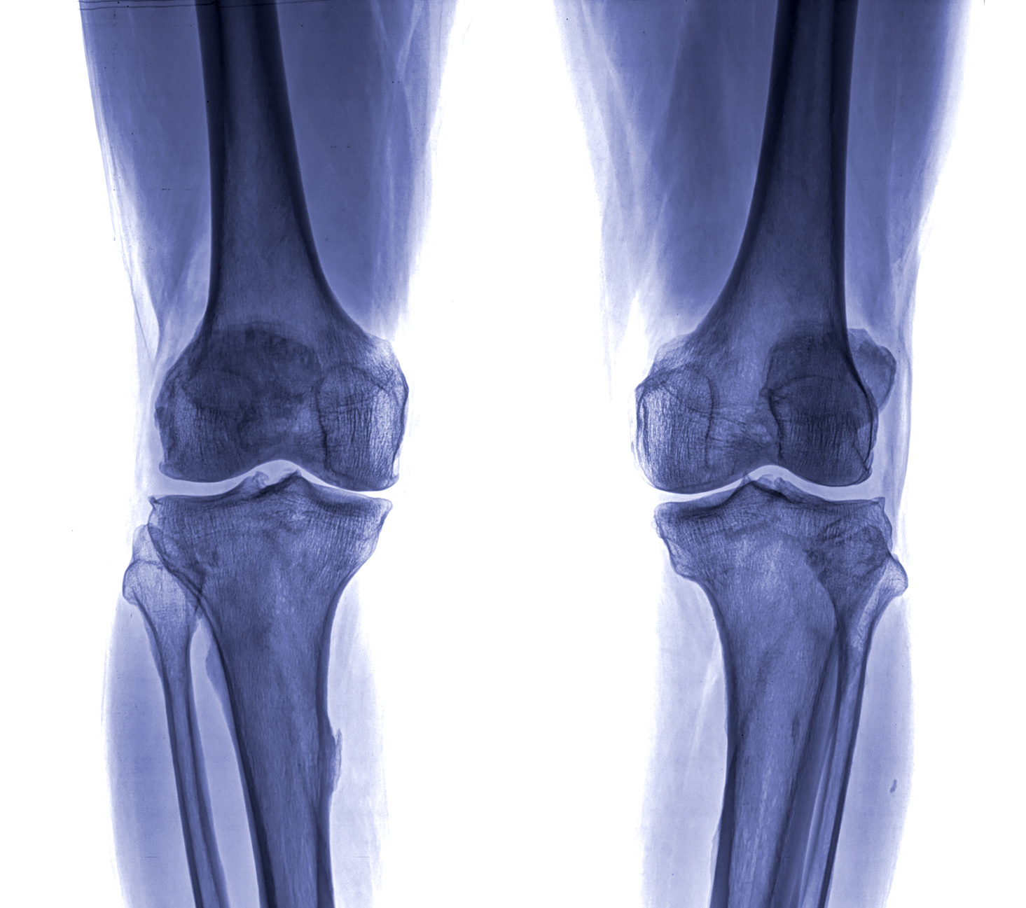 Funny knee xray 🌈 My Biomet knee replacement - Imgur