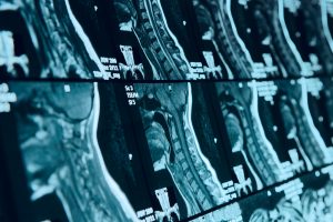 Cervical Spine Neck MRI Scan